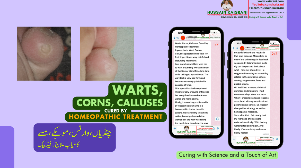 Homeopathic Treatment for Warts: How Dr. Hussain Kaisrani Healed My Painful Foot Wart