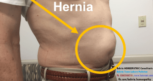 ہرنیا فتق: ہومیوپیتھک علاج – حسین قیصرانی HERNIA – Homeopathy Treatment and Homeopathic Remedies Urdu